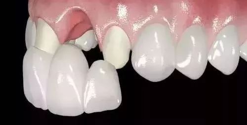 牙冠修复