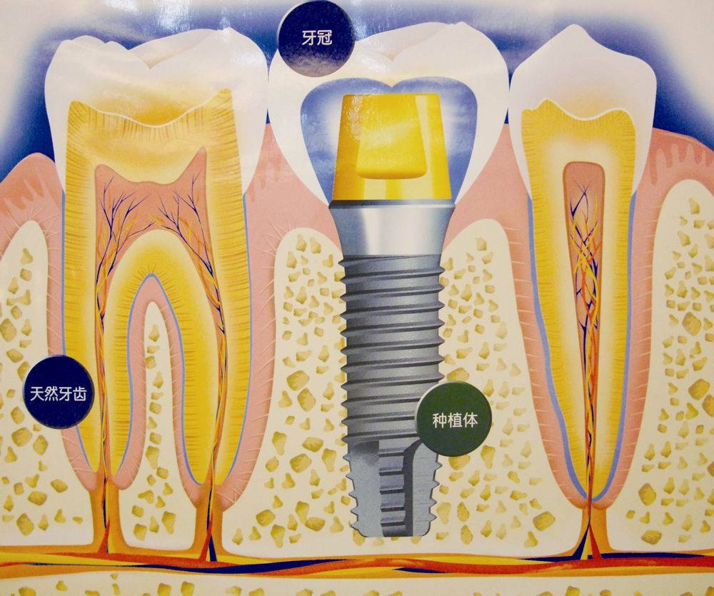 种植牙.jpeg