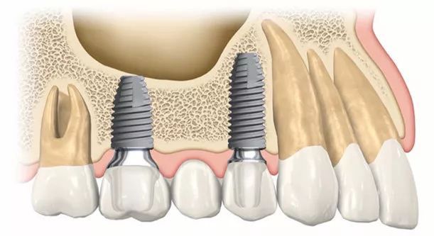 种植牙2.jpeg