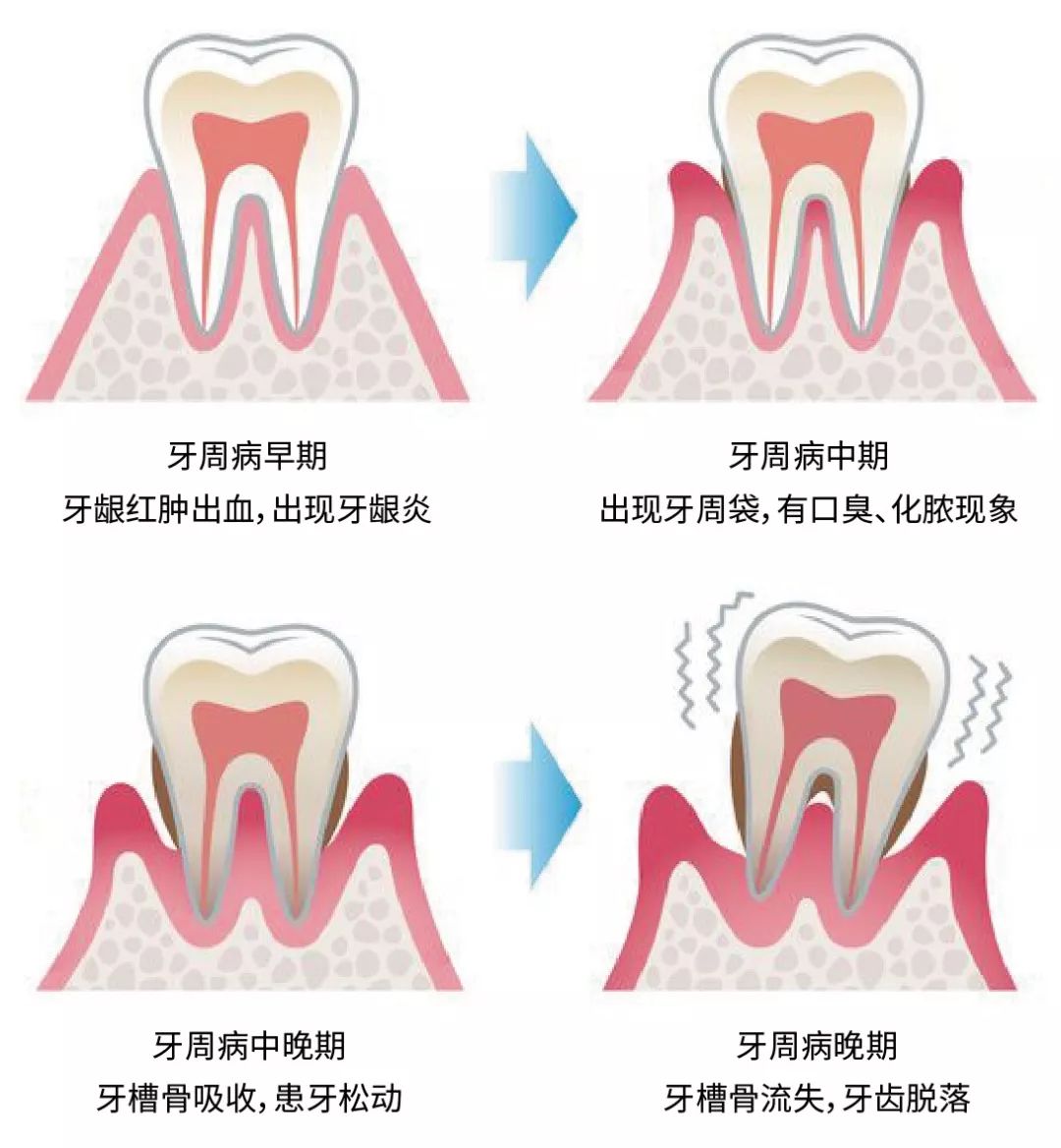 牙周病