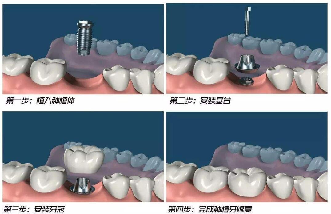 種植牙(1)