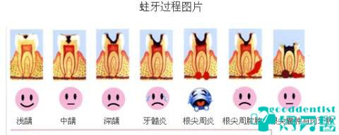 深圳補牙專科推薦-深圳補牙價目表-深圳補牙專家