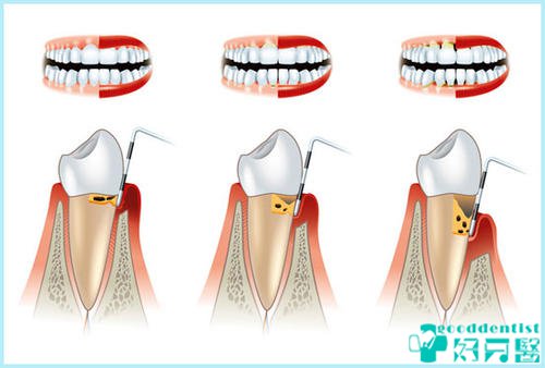 深圳牙周治療-牙周病-深圳好牙醫