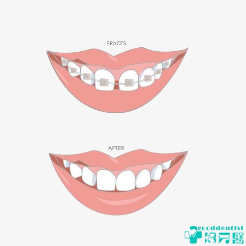 深圳箍牙-深圳牙齿矫正-深圳箍牙价目表-深圳好牙医